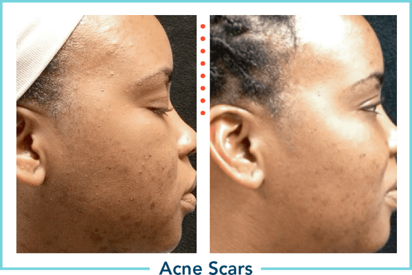 md-pen-optin-img-acne-difference-1.1