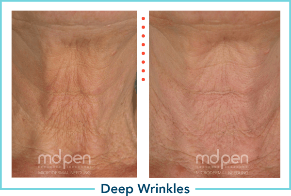 md-pen-optin-img-acne-difference-2
