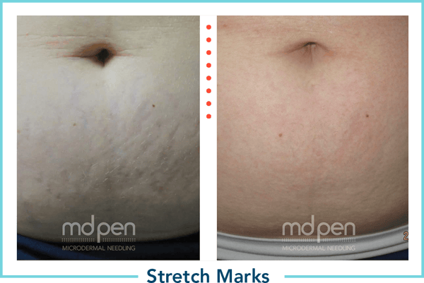md-pen-optin-img-acne-difference-3