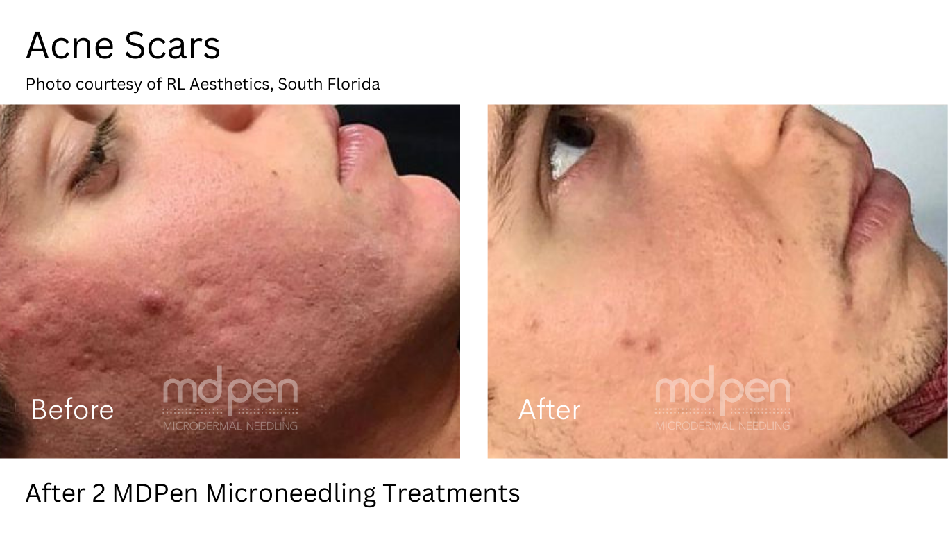 Microneedling before and after 1