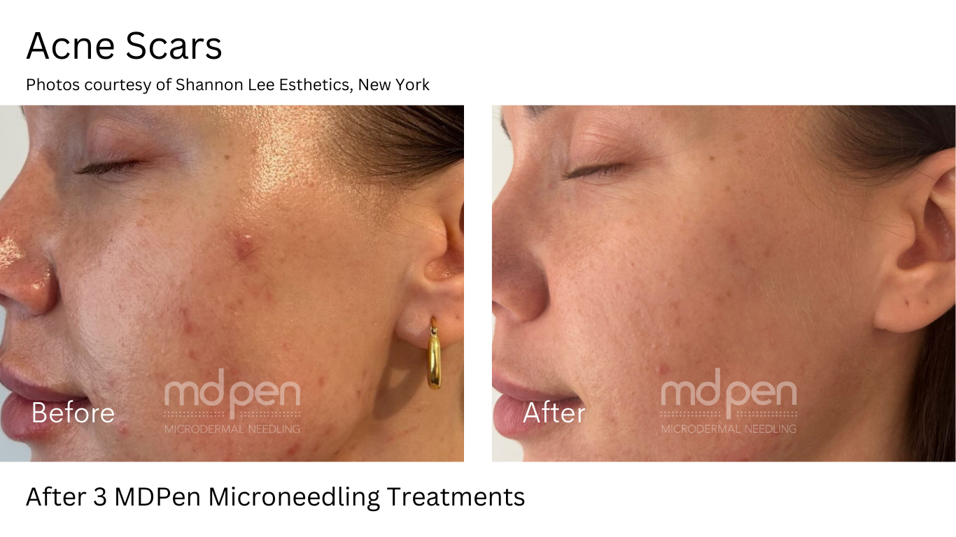 Microneedling before and after